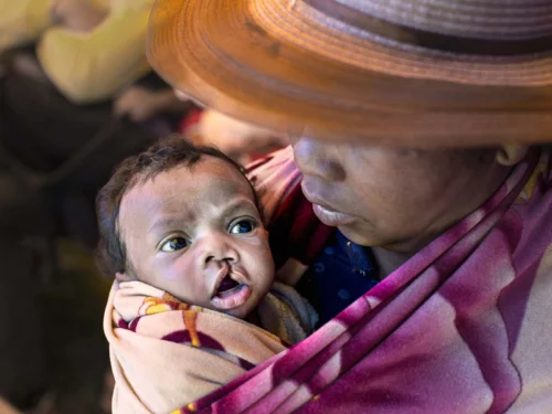 A mother cradles her child who, born with a cleft lip, struggles to feed.