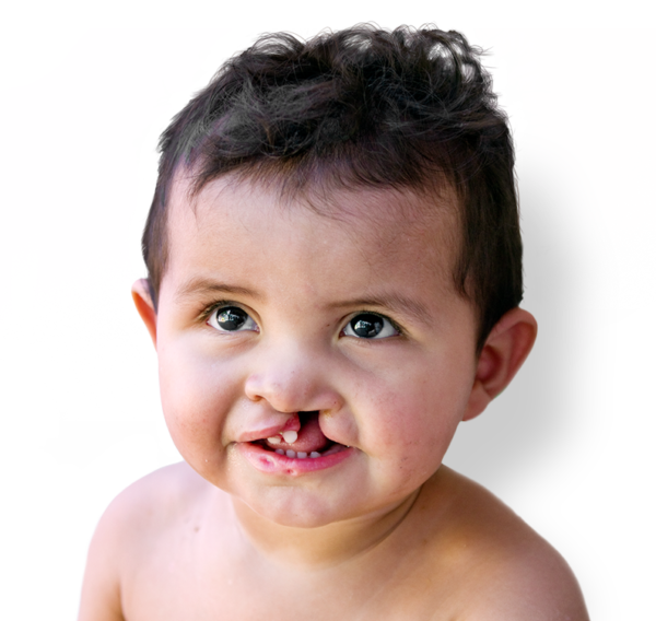 Our Work, providing cleft surgery to children - Operation Smile Canada