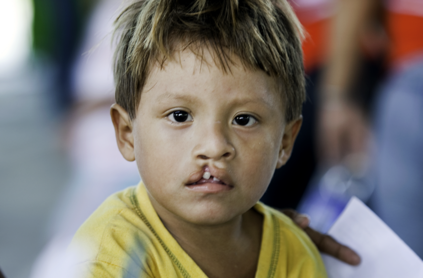 Close up of young boy with a cleft lip 