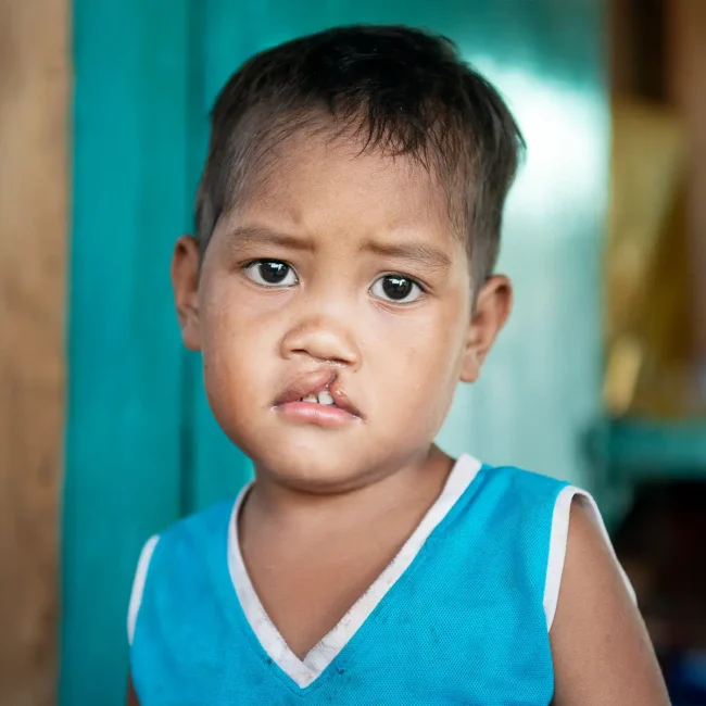 Jupiter, before surgery