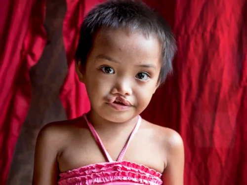 Jane Rose Amoro, 7, Before her surgery