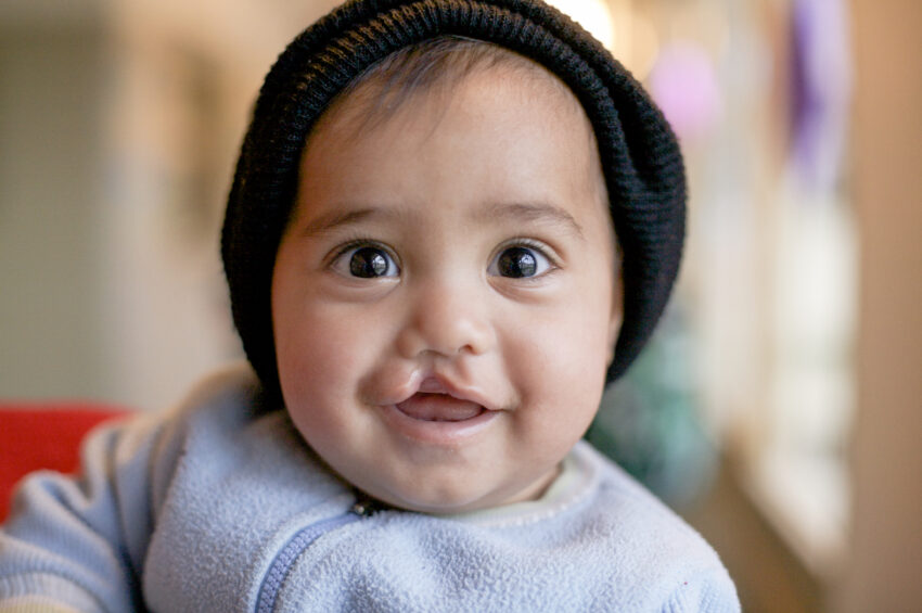 A baby boy with a black hat smiles with a cleft lip