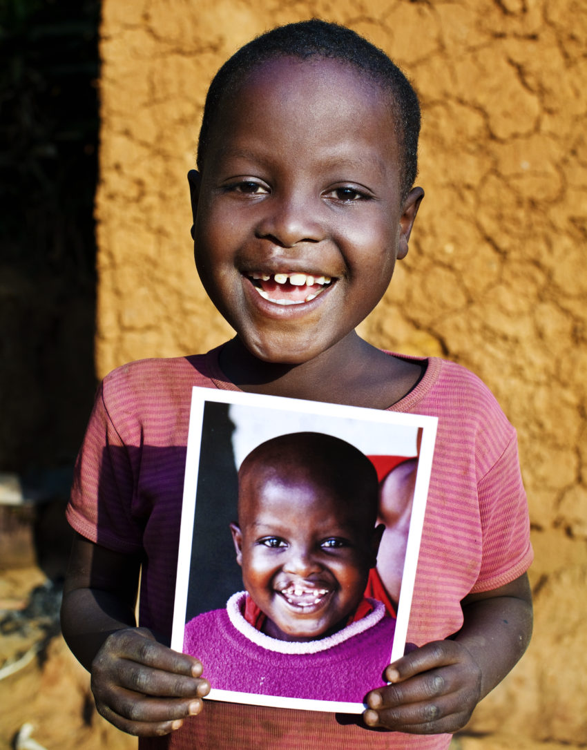 Boy holding photo of his younger self before he received cleft surgery in Kigali