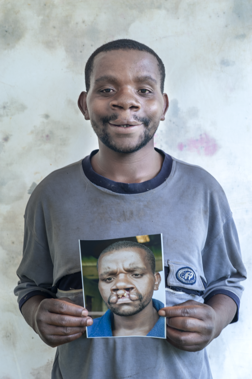 Male, 25, proudly showing off his new smile, months after receiving cleft lip surgery in Musanze, Rwanda, while holding a photo of his younger self before the surgery.