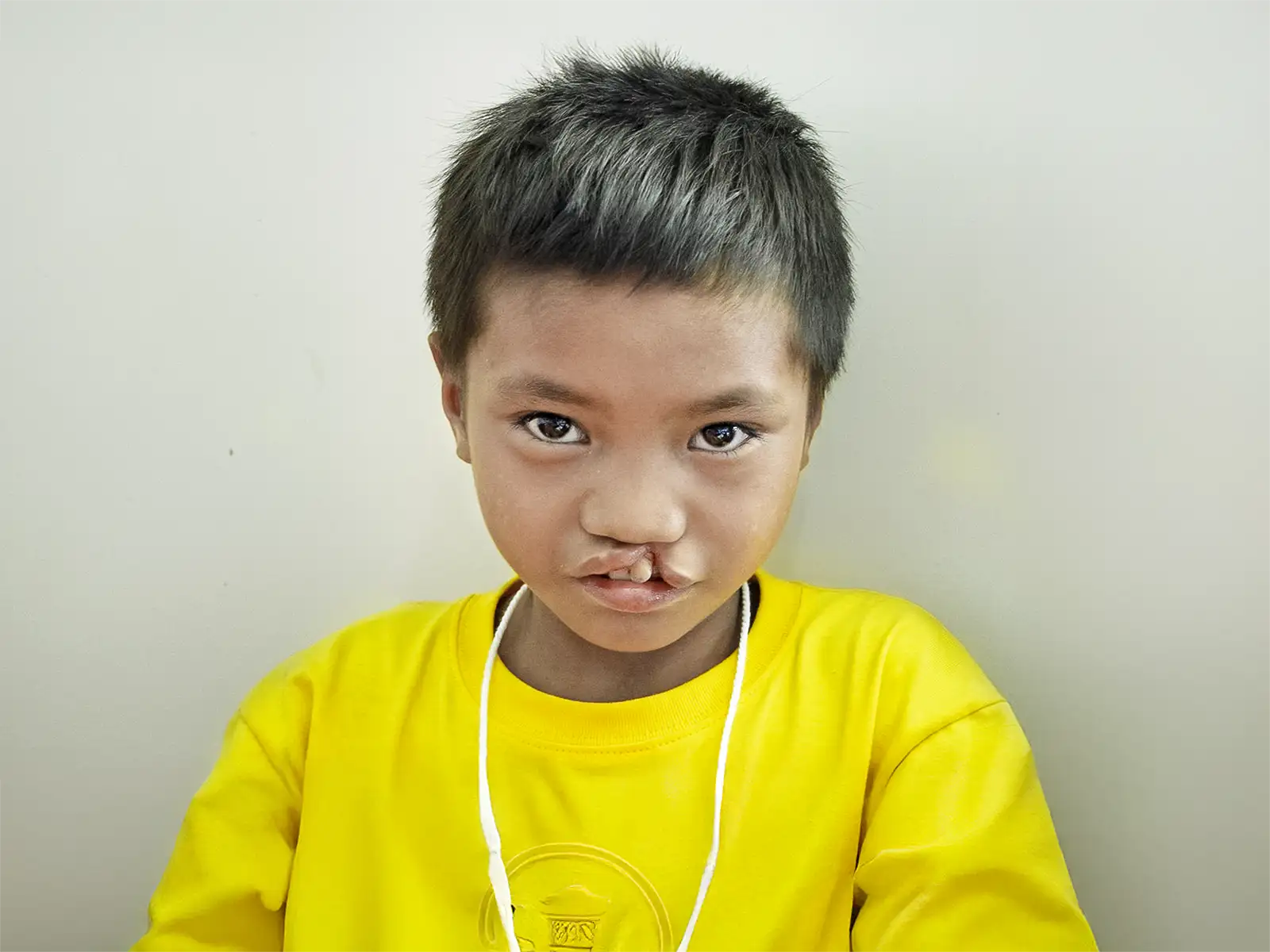 Say Eh Htoo, 10 years old - before surgery