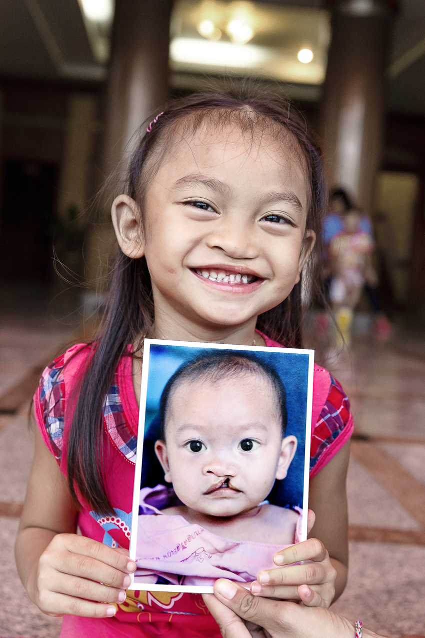 Youn girl smiles while holding a photo of her younger self before receiving her cleft surgery.