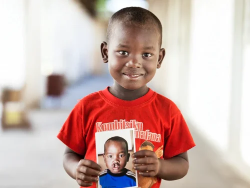 Tommy Vavatenina from Madagascar. After Surgery