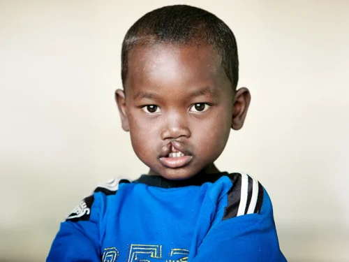 Tommy Vavatenina from Madagascar. Before Surgery.