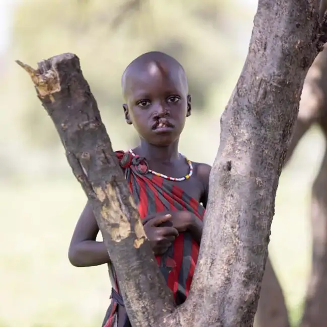A boy with a cleft condition hides behind a tree