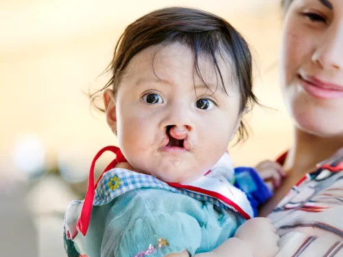 Valeria Luz Limachi Llange 7 Months old from Bolivia. Before Surgery