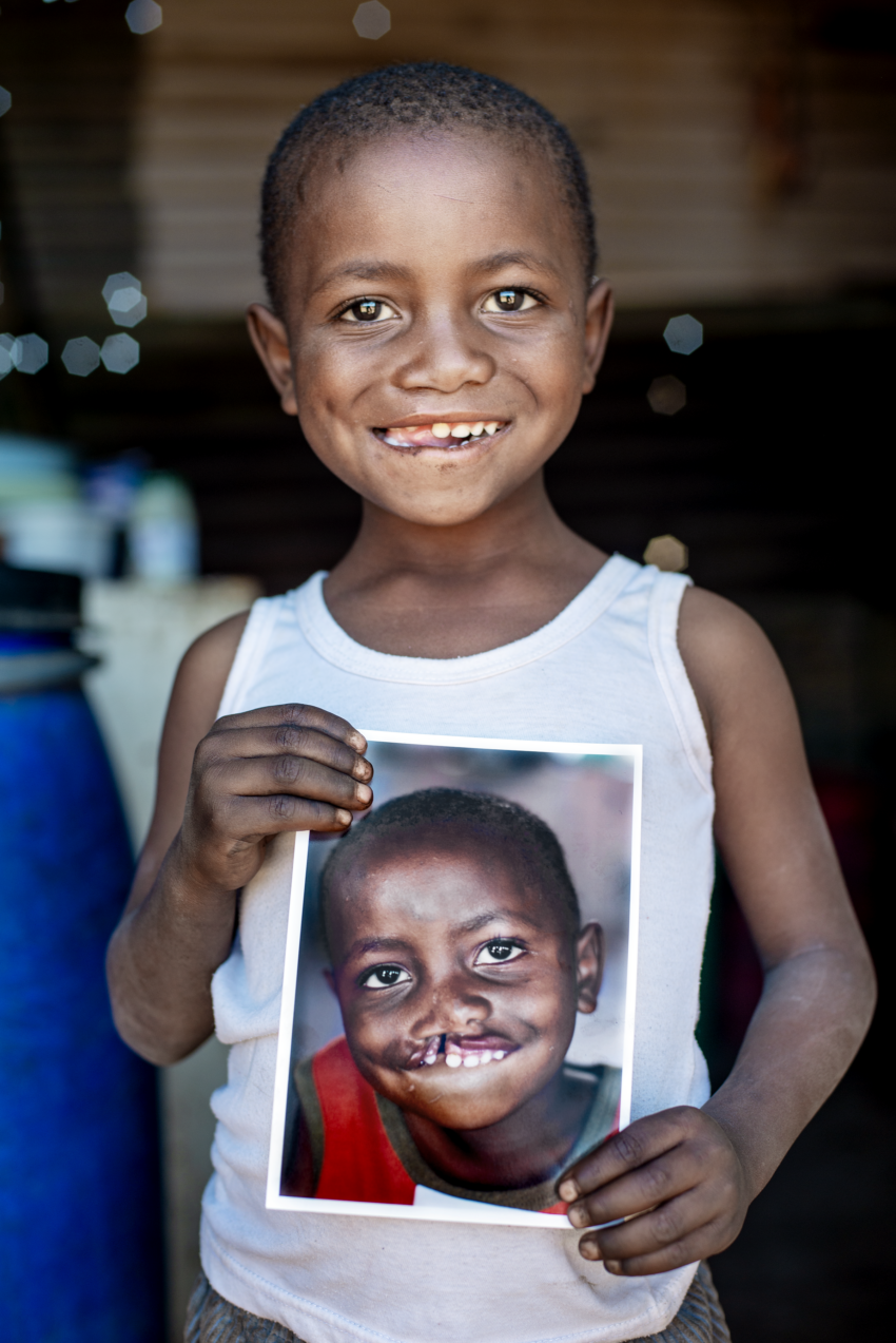 A 5-year-old boy, born with a unilateral cleft lip, poses with a photo of himself before his surgery.